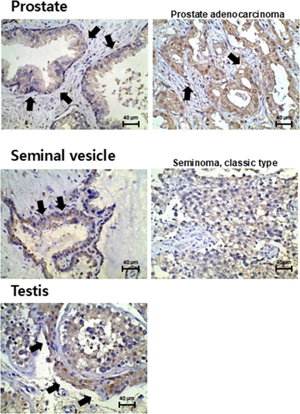 Correction to: Expression profiles of HERV-K Env protein in normal and cancerous tissues