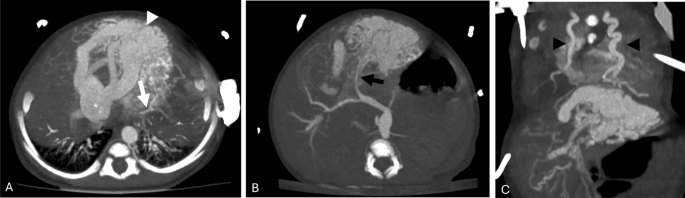 Reply to “Endovascular Treatment of an Arteriovenous Malformation of the Liver in a Neonate Using Liquid Embolization”