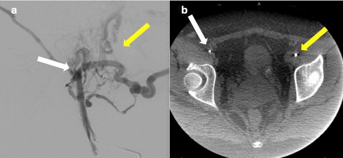 Excimer Laser Recanalization of a Chronically Occluded Iliofemoral Vessel with Cone-Beam CT Guidance