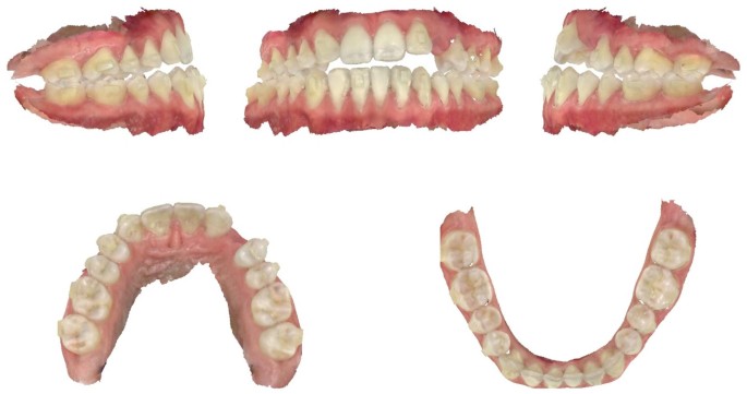 Intraoperative Intraoral Scanning to Enable Early Postoperative Clear-Aligner Therapy After Orthognathic Surgery