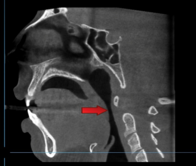Volumetric Analysis of Airway in Snoring Patients at Risk for Obstructive Sleep Apnea
