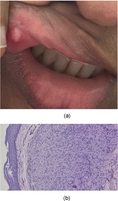 Neurofibroma of the Upper Lip: A Rare-Case Presentation