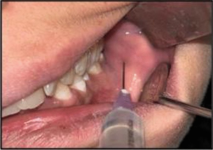 Dexamethasone Dynamics: A Split-Mouth Trial of Two Routes of Delivery in Third Molar Surgery