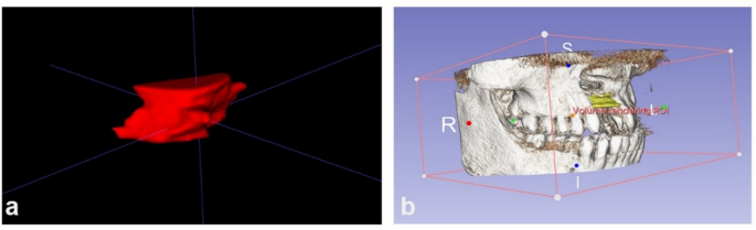 Clinical Challenges in Tertiary Alveolar Bone Grafting for Implant-Based Rehabilitation of Congenital Alveolar Cleft Patients