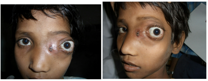 Maxillo-Ethmoido-Frontal Osseous Hamartoma in Tuberous Sclerosis Complex: A 17-Year Post-operative Reassessment