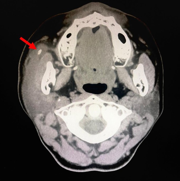 Parotid Duct Penetration of Face-Lifting Absorbable Thread Identified Incidentally During Sialendoscopic Removal of Parotid Gland Sialolith