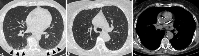 Lung cancer screening: current knowledge, opportunities, and challenges