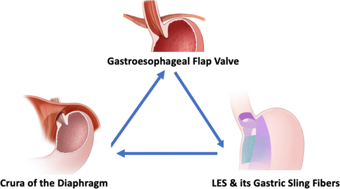 Association of GERD with Sleeve Gastrectomy: An Unintended Consequence