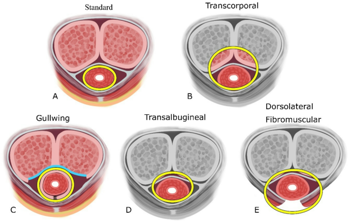 Modifications of Anti-Incontinence Procedures for Radiated Patients: A Narrative Review