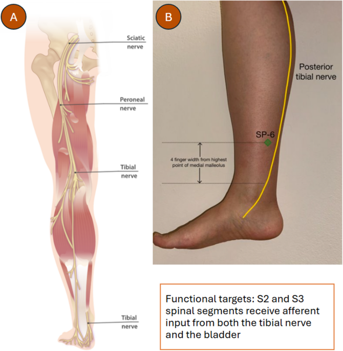 Tibial Nerve Stimulation: Recent Progress and Challenges