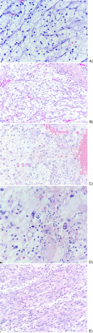 Sarcomatoid Renal Cell Carcinoma: Biological Features and Therapeutic Implications—A Narrative Review