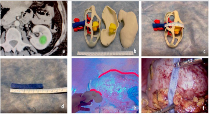 Minimally Invasive Surgery in Solitary Kidneys with Renal Tumors: A Surgical Evolution