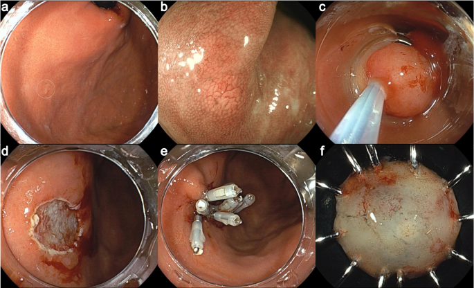 Feasibility study of cap-assisted endoscopic mucosal resection for gastric adenocarcinoma of fundic gland type