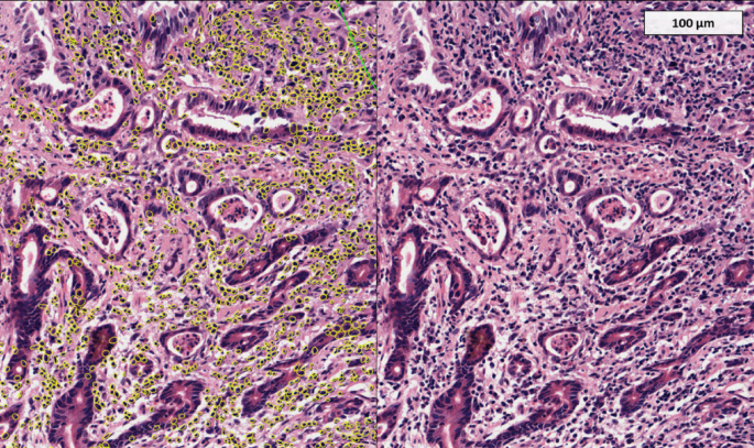 The density of tumour infiltrating lymphocytes in oesophago-gastric cancer varies with disease stage, geographical region and treatment: a post hoc analysis of nine phase III clinical trials