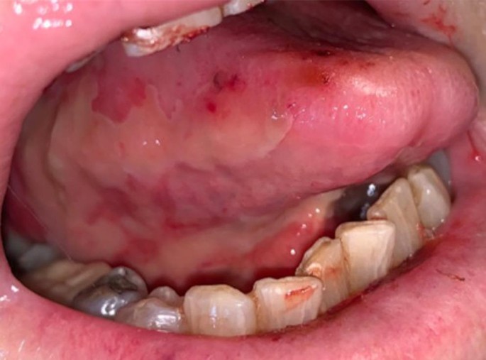 Regimen-Related Oral Mucosal Injury: Pathobiology, Clinical Consequences and Rationale for Intervention Across Cancer Treatment Modalities