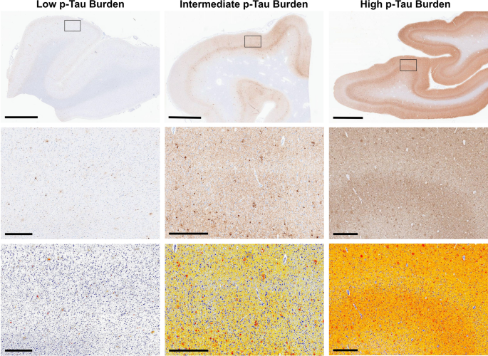 Neocortical tau burden determines the degree of cognitive impairment in individuals with Braak stage V neurofibrillary degeneration