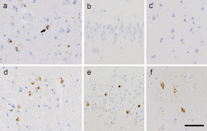 ε4 influences the widespread TDP-43 pathological subtype in sporadic amyotrophic lateral sclerosis
