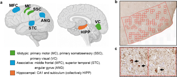 Idiotypic-susceptible Alzheimer’s disease: a clinically relevant, neurofibrillary tangle subtype