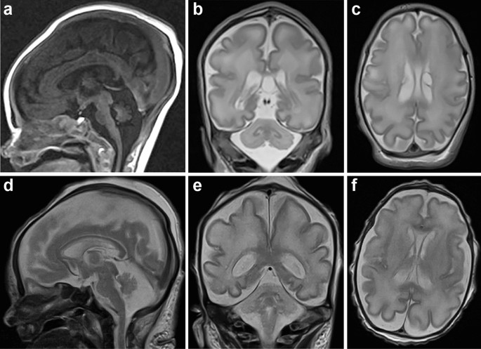 A severe neurodevelopmental syndrome linked to a South Asian founder variant in the UFMylation adaptor