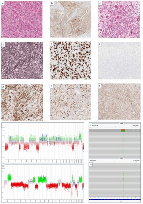 Loss of meningothelial identity and mesenchymal fate switching in NF2-mutant meningiomas