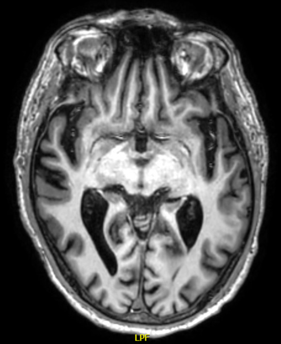 Diagnostische Herausforderungen des Korsakow-Syndroms: Ein Fallbericht