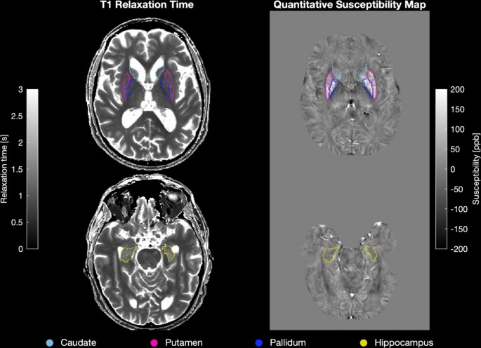 Epileptiform discharges in neurodegenerative diseases linked to atrophy but not associated with iron depositions
