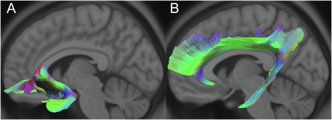 White matter and impulsivity are prospectively associated with non‑suicidal self‑injury in youth: evidence for sex differences