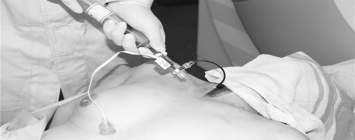 Diagnosis of Vascular Rupture Due to Arteriovenous Malformation Using Postmortem Angiography and 3-Dimensonal Printing: A Case Report