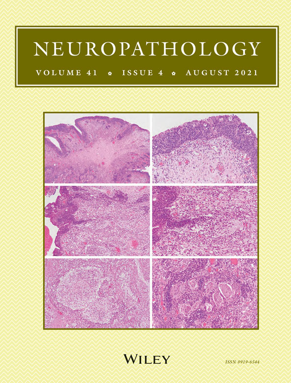 Ependymosarcoma harboring C11orf95:RELA fusion transcript: Report of two cases and review of the literature