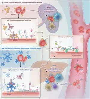 Autoimmune Hemolytic Anemias