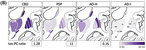 Distinct subcortical tau burden: The tau pallido‐claustral ratio separates progressive supranuclear palsy and corticobasal degeneration