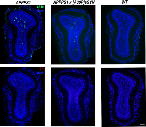 Distinct Aβ pathology in the olfactory bulb and olfactory deficits in a mouse model of Aβ and α‐syn co‐pathology