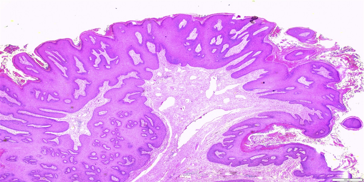 Buschke-Lowenstein Tumors: A Review and Proposed Classification System