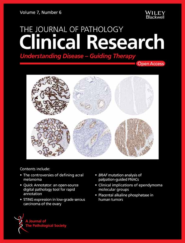 Papillary thyroid carcinoma tall cell variant shares accumulation of mitochondria, mitochondrial DNA mutations, and loss of oxidative phosphorylation complex I integrity with oncocytic tumors