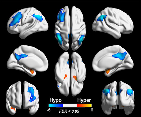 18F‐fluorodeoxy‐glucose positron emission tomography pattern and prognostic predictors in patients with anti‐GABAB receptor encephalitis