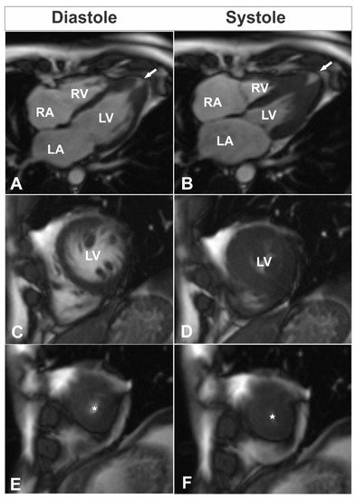 Cardiogenetics, Vol. 11, Pages 31-38: Overlapping Phenotype of Cardiomyopathy in a Patient with Double Mutation: A Case Report