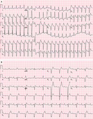 Hypertensive Heartbreak