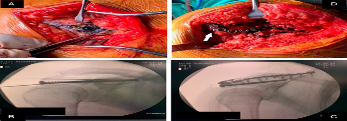 Intramedullary Screw Fixation Supplemented by Scapular Spine Plating: A Surgical Technique for the Base of Acromion Fracture