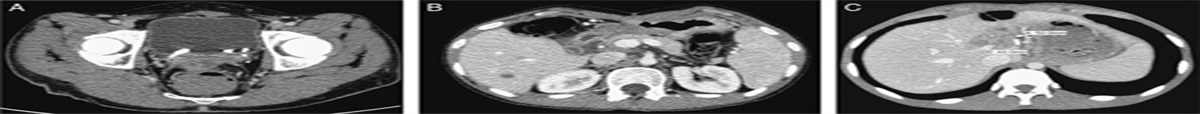 The addition of autologous stem cell transplantation to neoadjuvant chemotherapy, radiation, and HIPEC for patients with unresectable desmoplastic small round cell tumor: a single center case series