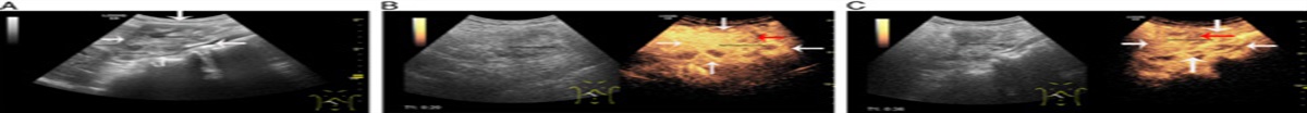 Xanthogranulomatous pancreatitis combined with multifocal necrosis: A case report and literature review
