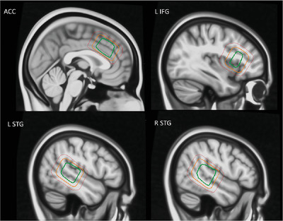 Negative valence of hallucinatory voices as predictor of cortical glutamatergic metabolite levels in schizophrenia patients