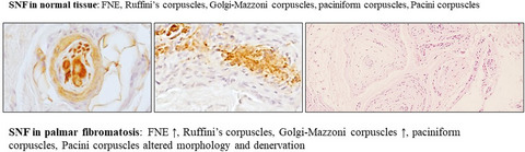 Sensory innervation of the human palmar aponeurosis in healthy individuals and patients with palmar fibromatosis