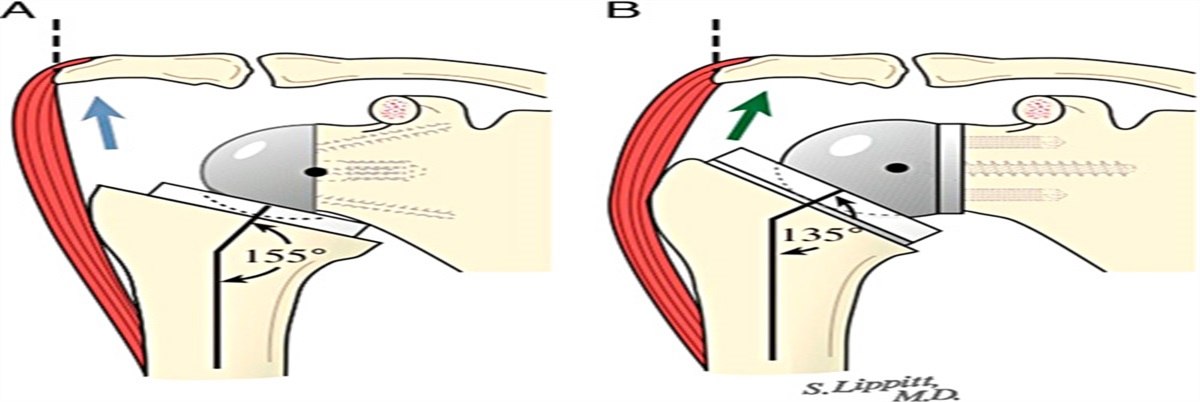 Lateralized Versus Nonlateralized Reverse Shoulder Arthroplasty: Impact on Clinical and Functional Outcomes