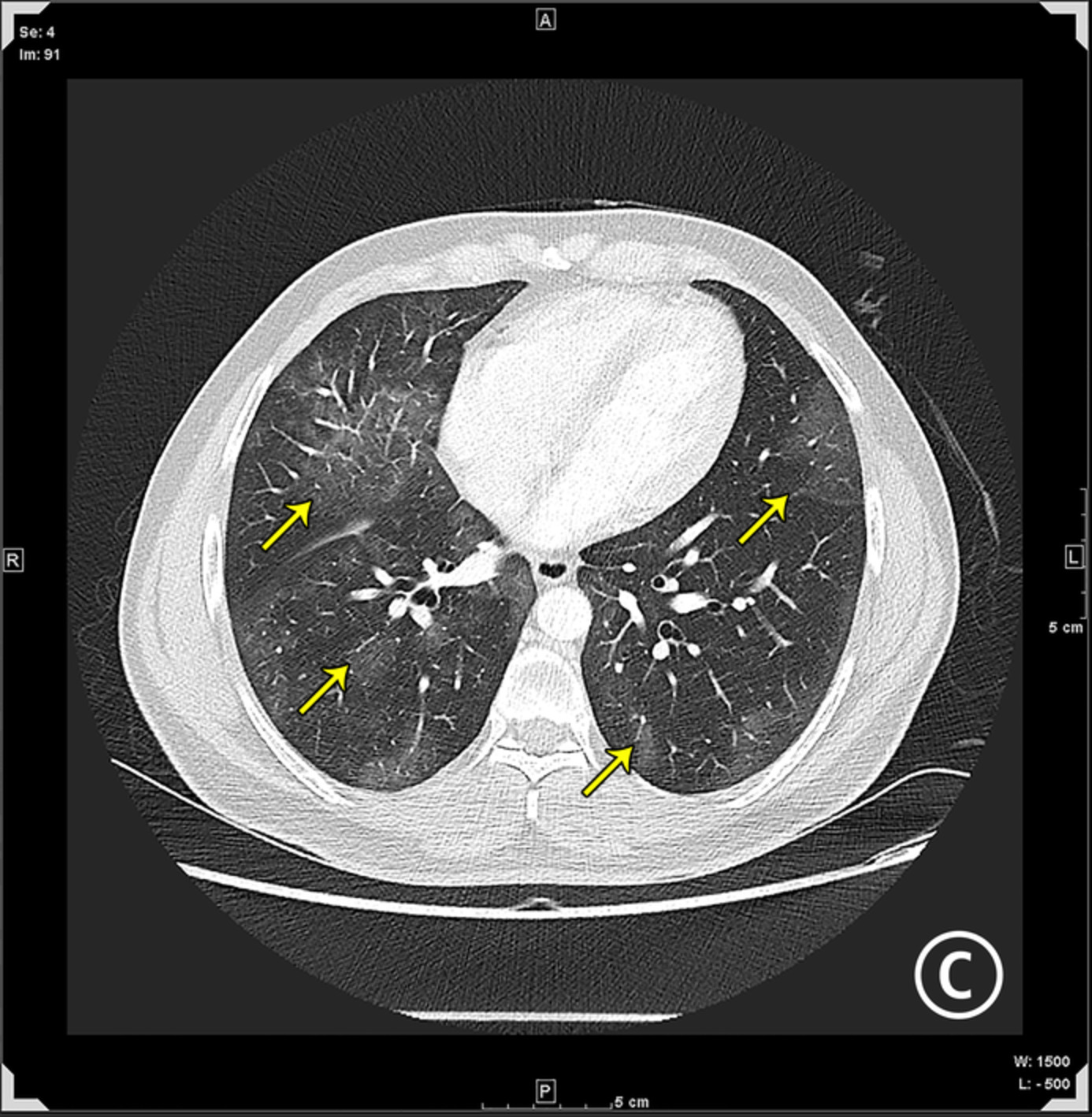 Recurrent COVID‐19 infection in a case of rituximab‐induced hypogammaglobulinaemia