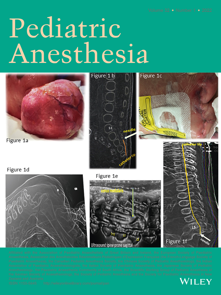 Association between implementation of a coordinated care pathway in idiopathic scoliosis patients and a reduction in perioperative outcome disparities