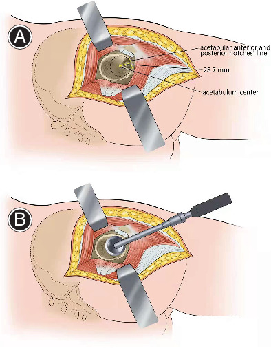 Restoring Rotation Center in Total Hip Arthroplasty for Developmental Dysplasia of the Hip with the Assistance of Three Dimensional Printing Technology: A Pilot Study