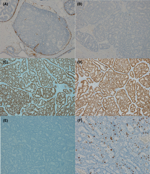 Invasive cribriform carcinoma of the breast detected incidentally on computed tomography: A case report