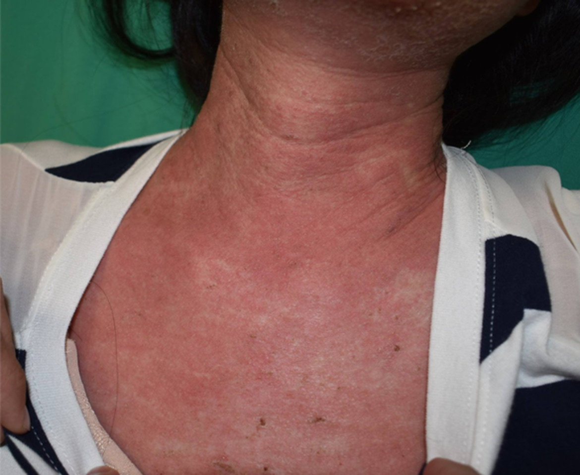 Successful erlotinib rechallenge in an EGFR‐mutant metastatic non‐small cell lung cancer patient with afatinib‐induced drug rash with eosinophilia and systemic symptoms: A case report
