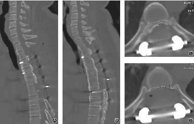 Long‐Term Follow‐Up of Multilevel Thoracic Ossification of the Posterior Longitudinal Ligament Following Circumferential Decompression via Posterior Approach: A Retrospective Study