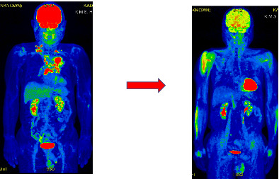 Dramatic response to immunochemotherapy followed by salvage surgery in an elderly lung cancer patient